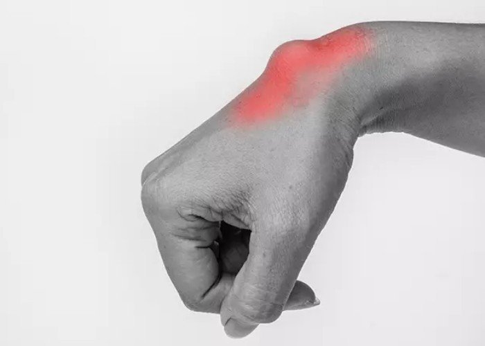 Remoção de Cisto Sinovial