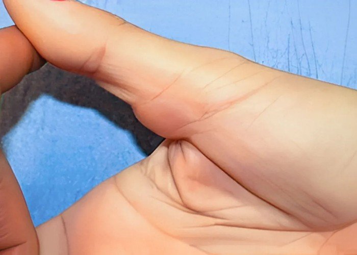 Cirurgia de Tumores da Mão