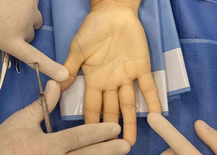 Reparo de Tendões da Mão