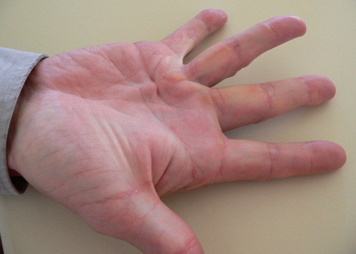 Tratamento da Doença de Dupuytren