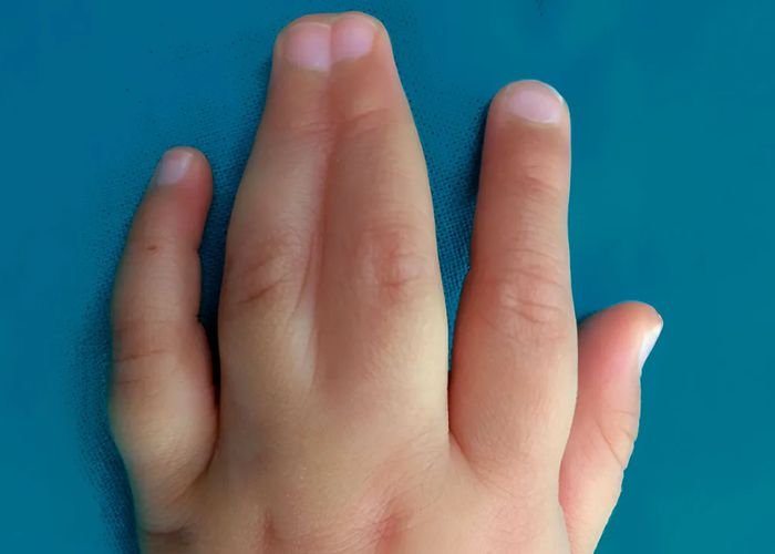 Tratamento de Deformidades Congênitas da Mão